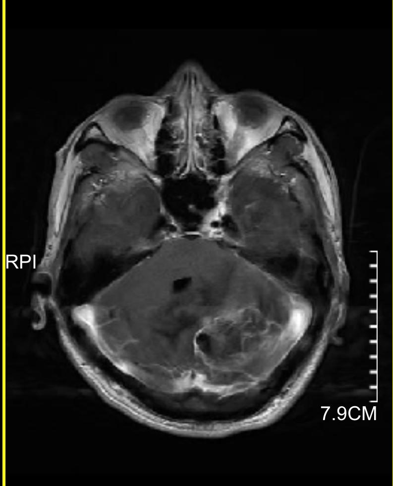 发现脑肿瘤怎么办,发现脑卒中前兆怎么办