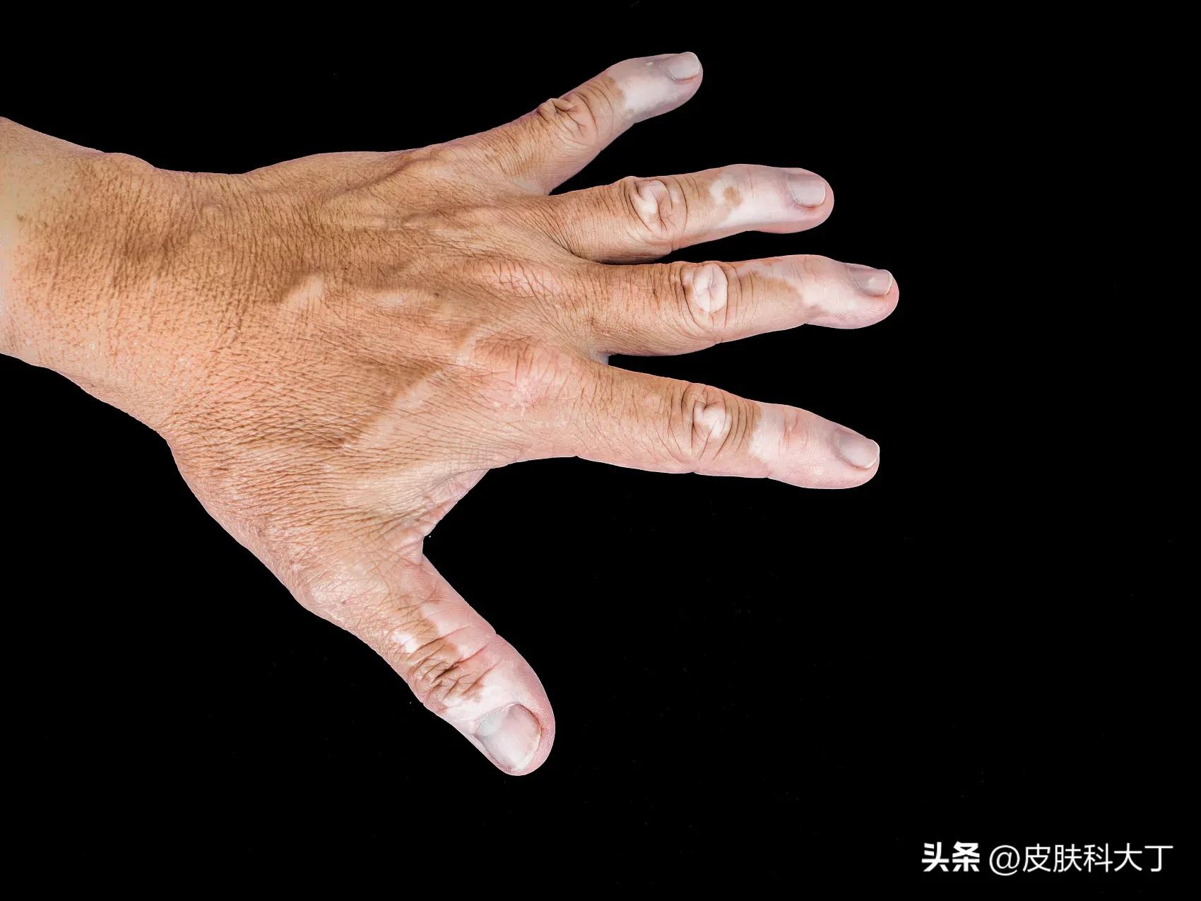 如何让白癜风彻底治愈,让白癜风快速扩散的药方