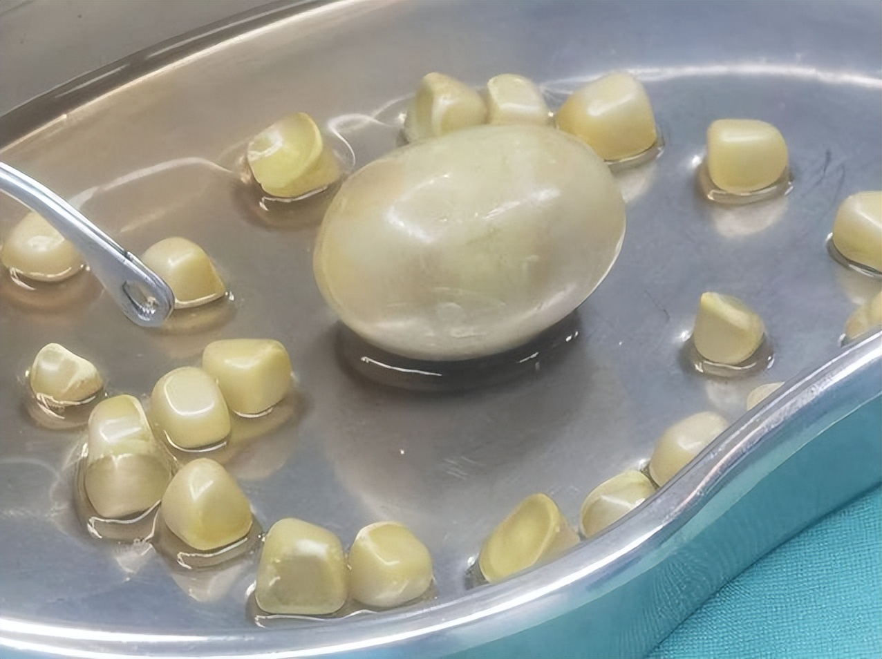 胆囊结石一般是什么色,胆囊结石的形状像米粒