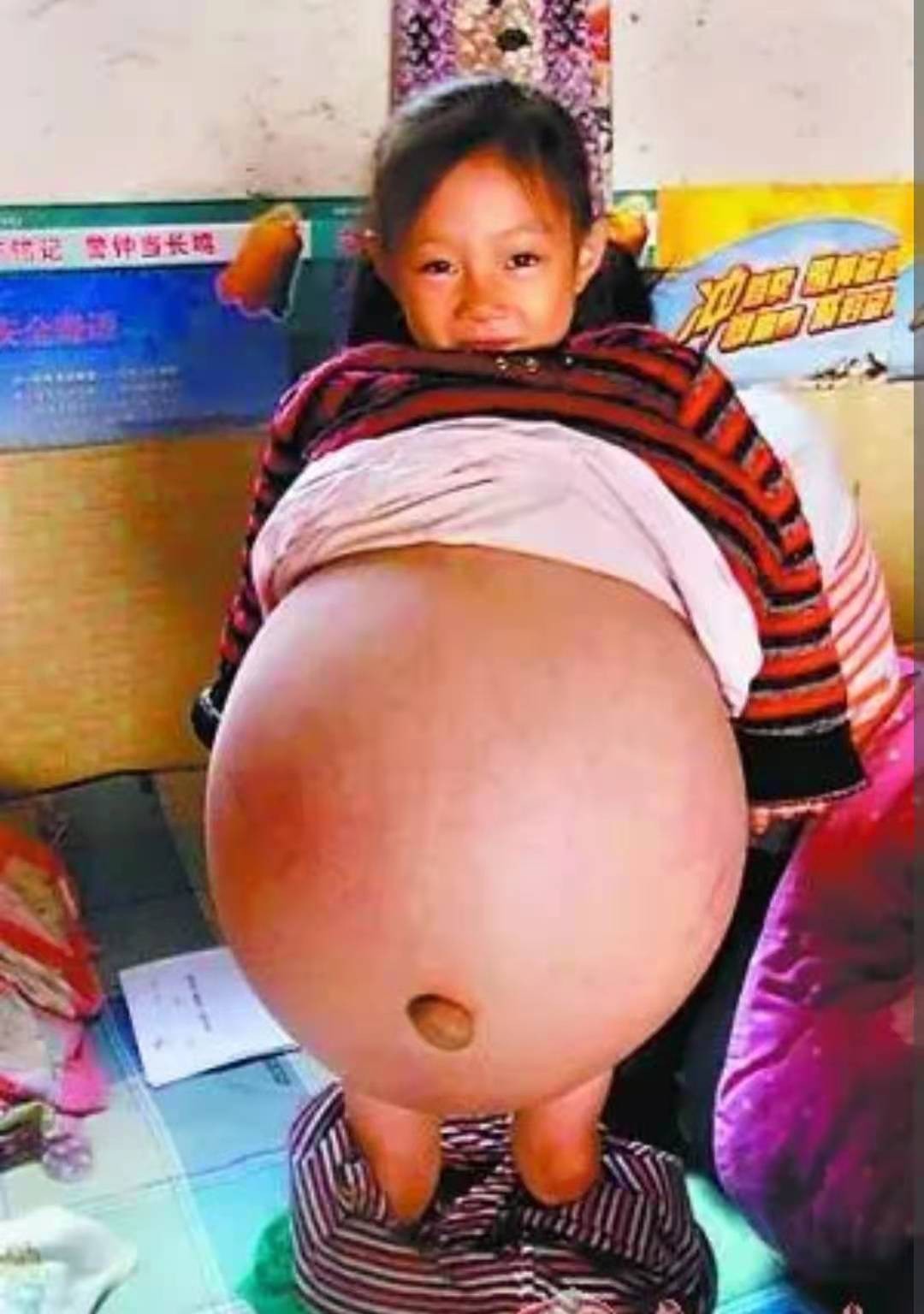 2010年一位山西4岁女童得“怪病”，肚子宽106厘米，后来治好了吗