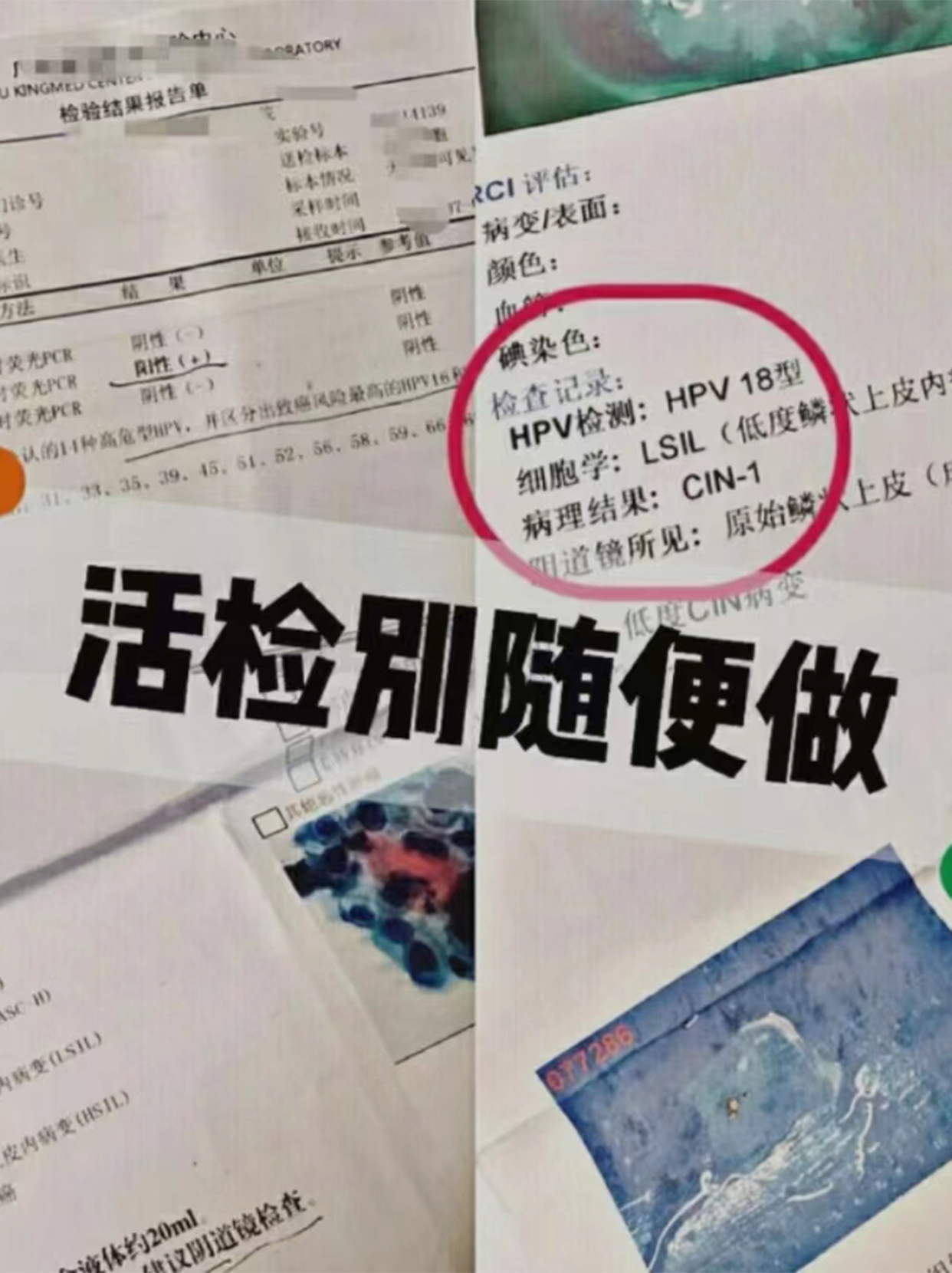 不是hpv感染宫颈低度病变,不是hpv引起的宫颈癌怎样检查