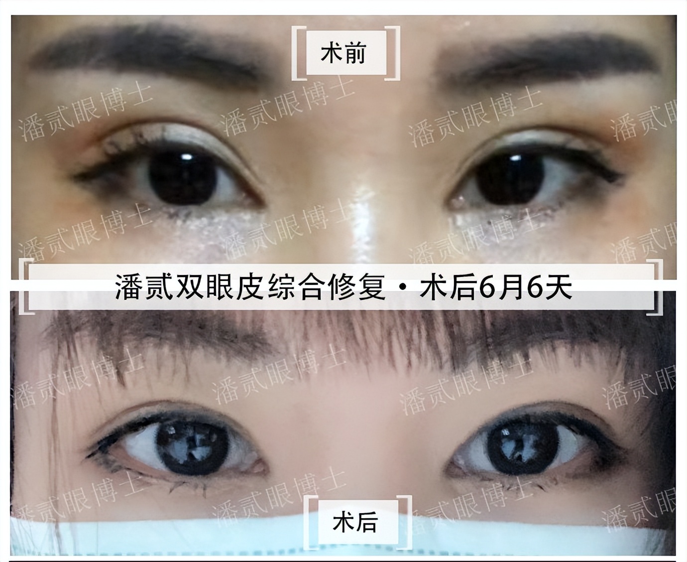 割双眼皮就割一只眼,割双眼皮提肌有风险吗