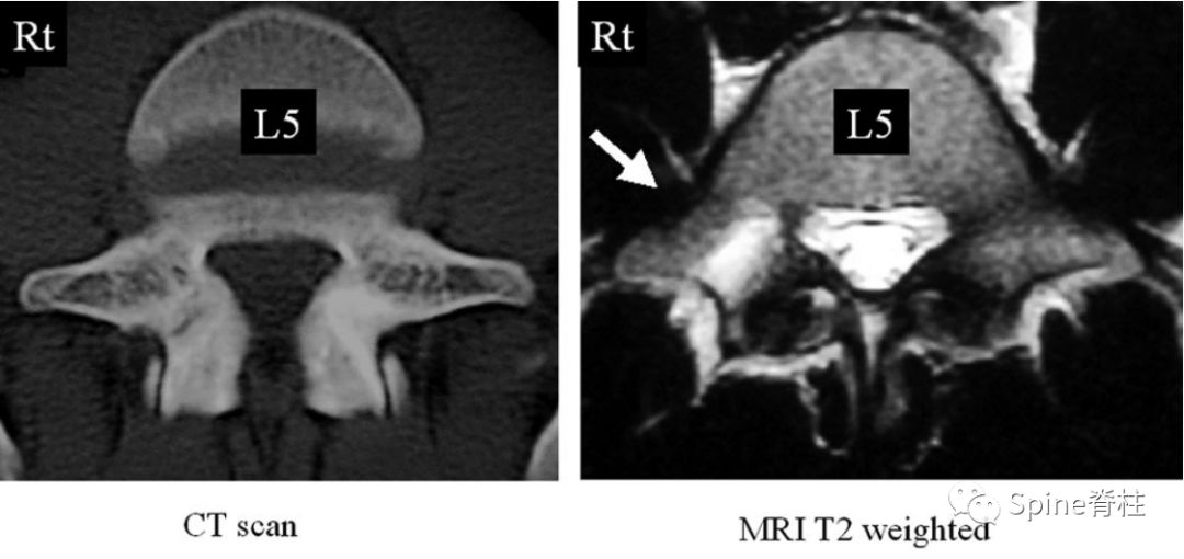 轻度峡部裂和重度峡部裂的区别,真性峡部裂和假性峡部裂