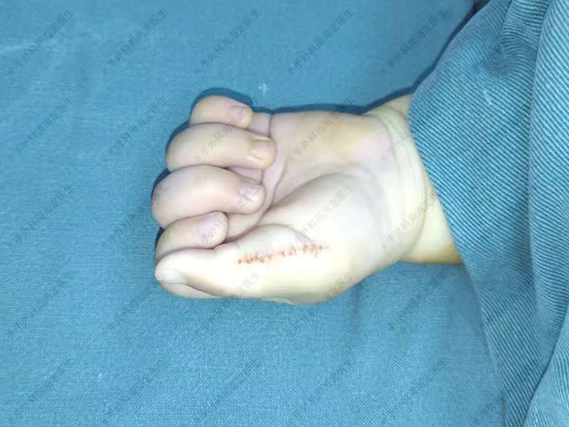 宝宝大拇指有两个可以切除吗,小孩多个手指头什么时候手术合适