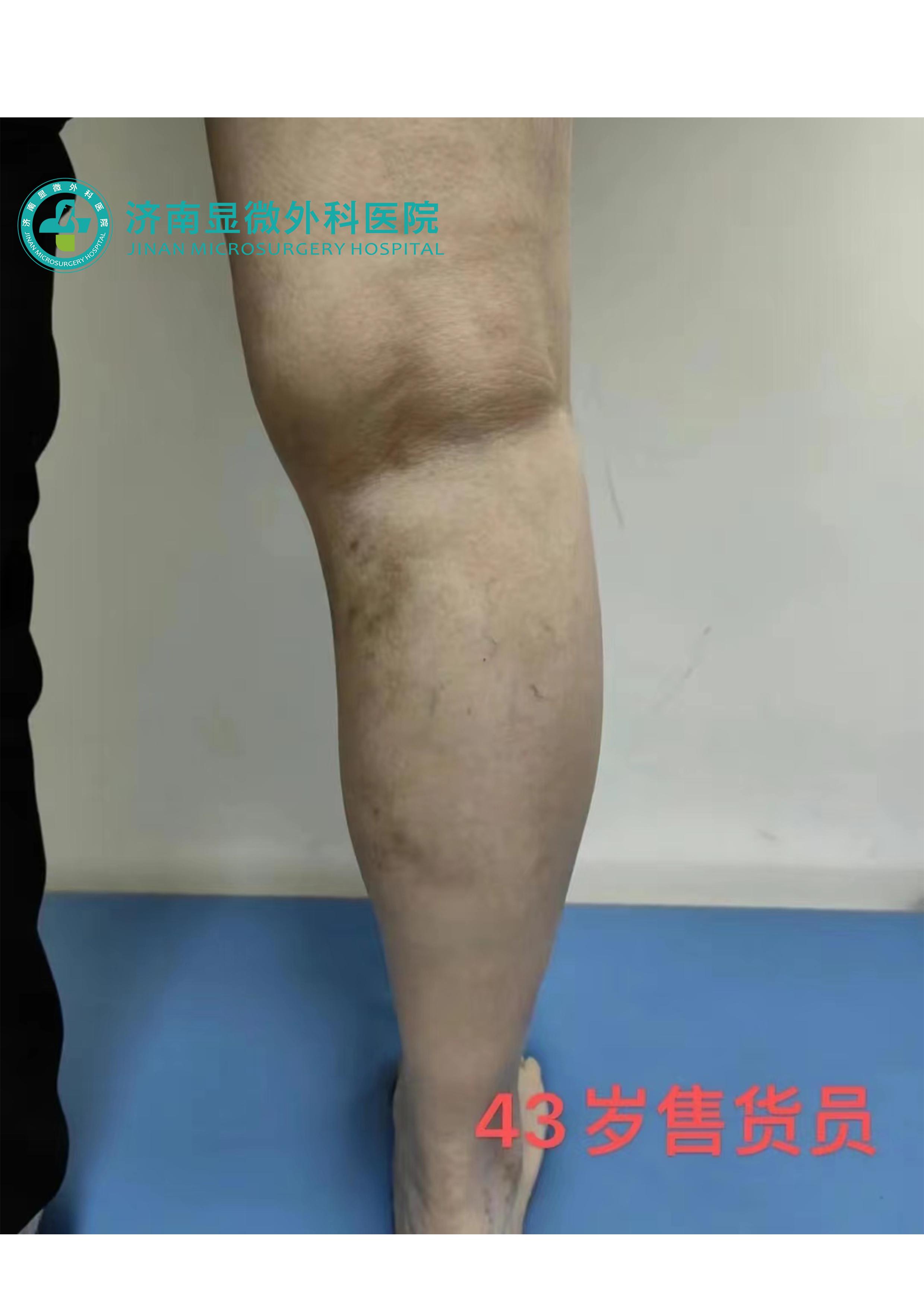 静脉曲张先期症状,静脉曲张早期症状及治疗