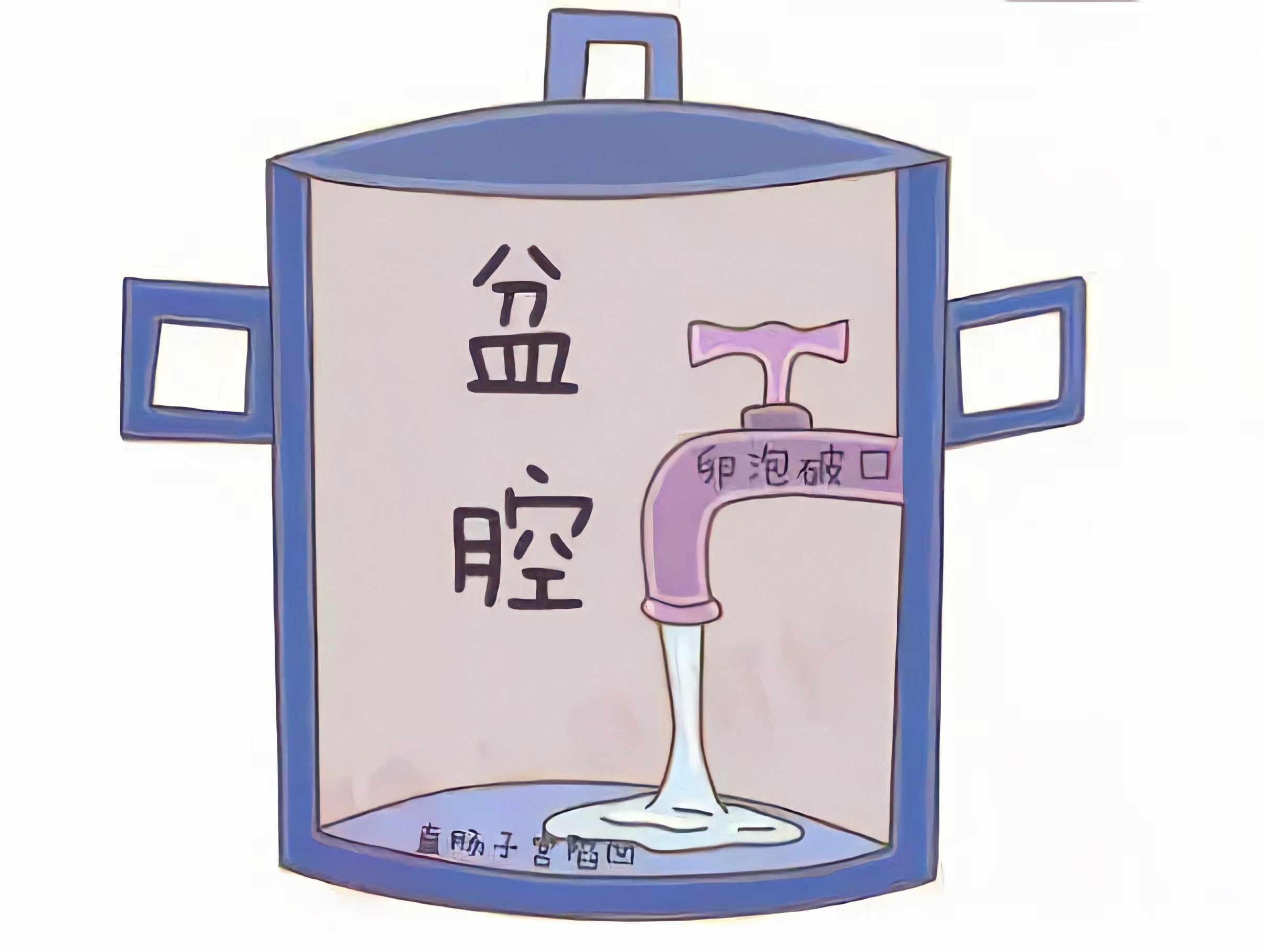 盆腔积液=盆腔炎？不要被它吓破了胆，范主任给你讲清楚、调正常