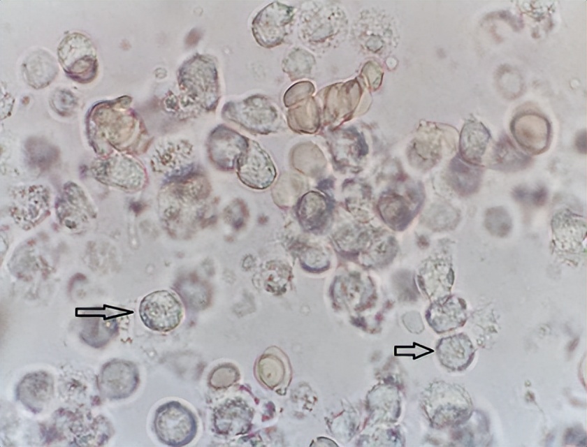 前列腺常规检查报告单正常,前列腺核磁共振报告单怎么解读