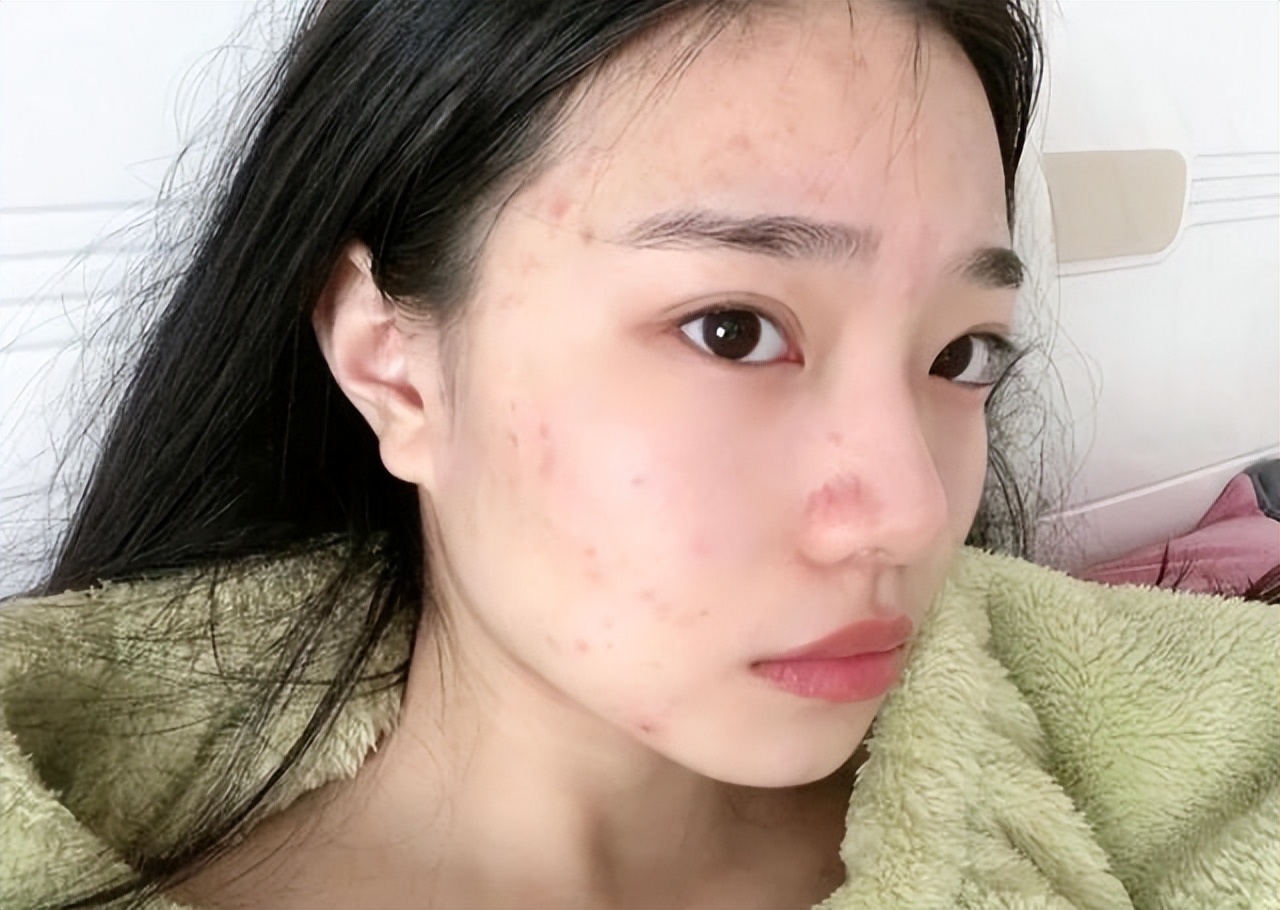 内行人推荐的护肤品,烂脸反复爆痘护肤品真实测评