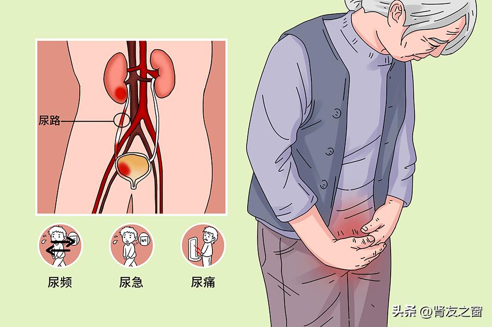 当2型糖尿病遇上尿路感染（二）