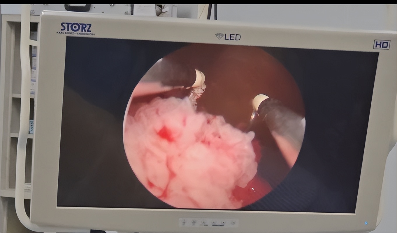 膀胱癌的诊断与鉴别诊断,膀胱癌的诊断与治疗