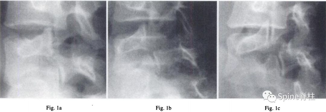 轻度峡部裂和重度峡部裂的区别,真性峡部裂和假性峡部裂