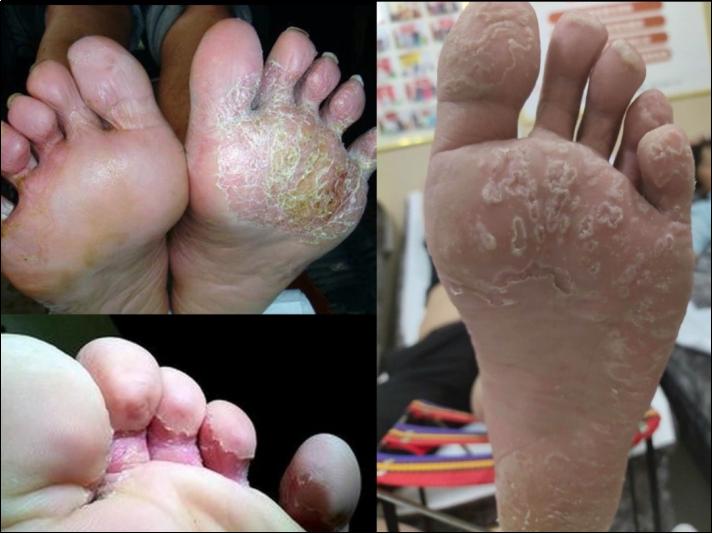 专业治脚气全国招商,脚气药加盟