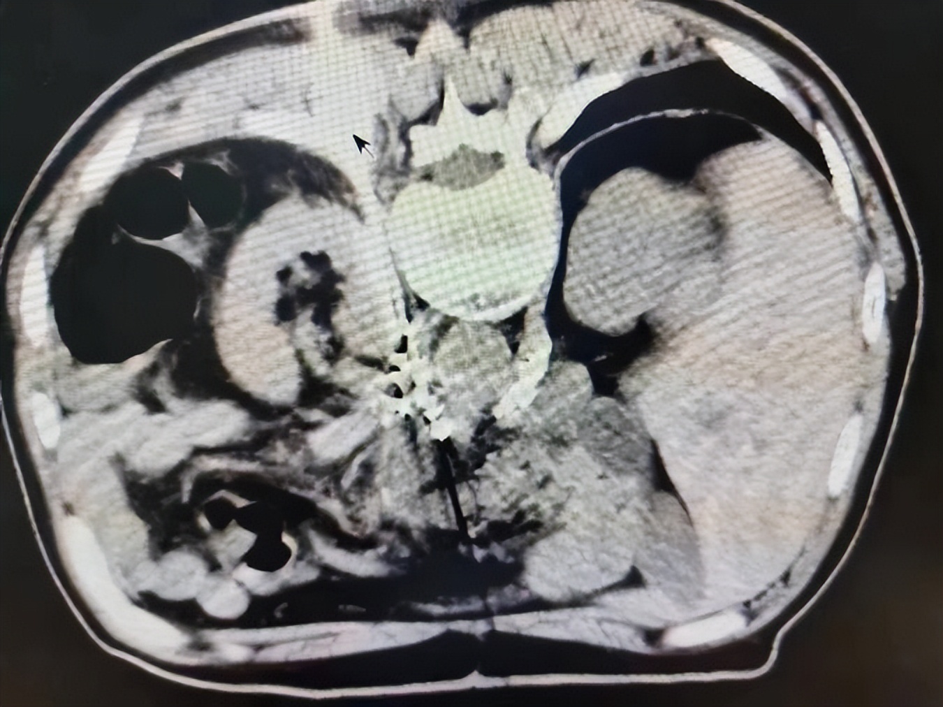 【病例档案馆】介入快报（第2期）