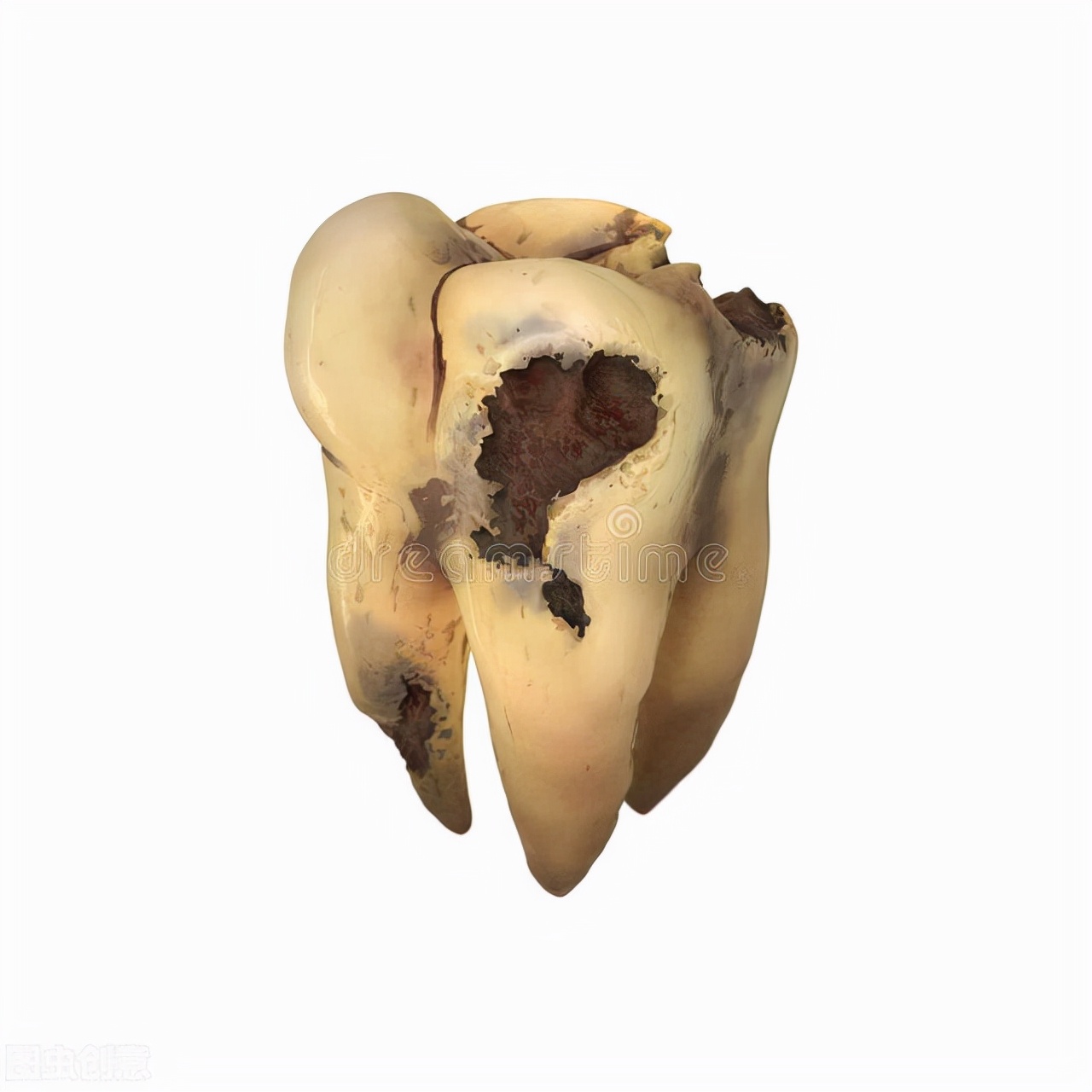 蛀牙痛怎么止痛最快最有效,蛀牙痛怎么缓解疼痛