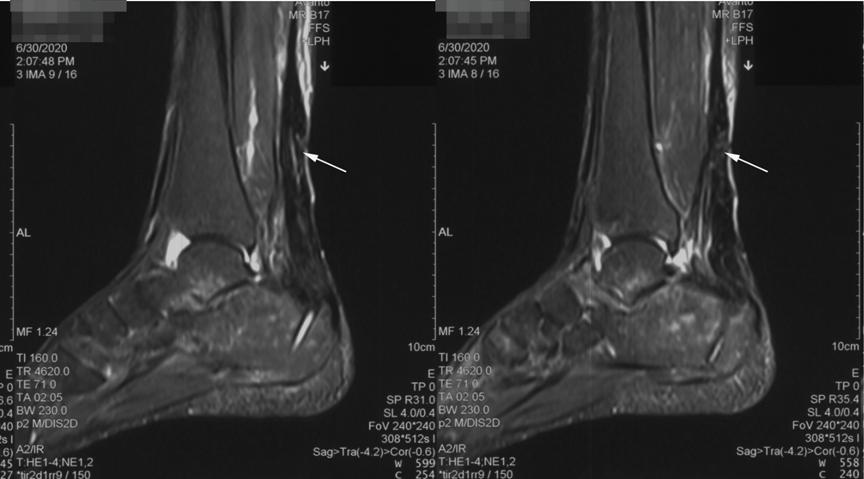 #非常病例#跳广场舞导致跟腱断裂，微创修补重返舞台