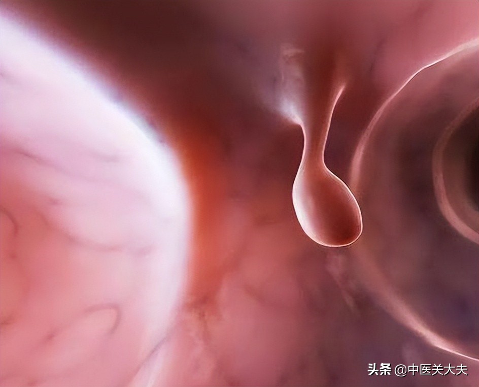 治胃息肉最好的偏方,吃多长时间中药可以治好胃息肉