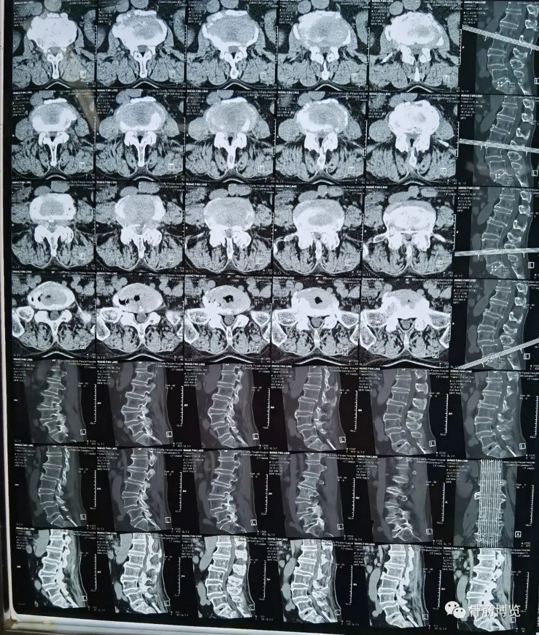 腰椎滑脱椎管狭窄手术后遗症,腰椎间盘突出椎管狭窄的手术