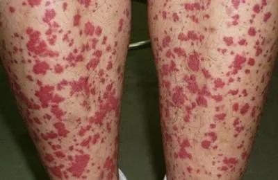 过敏性紫癜肾炎吃中药能治根吗,过敏性紫癜肾炎有必要做肾穿吗