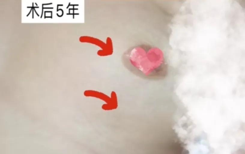 乳房缩小手术要多长时间才能恢复,乳房缩小上提手术后伤口不愈合