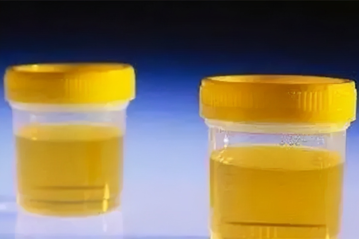 痛风怎样快速把尿酸降下去,痛风做什么运动降尿酸最快