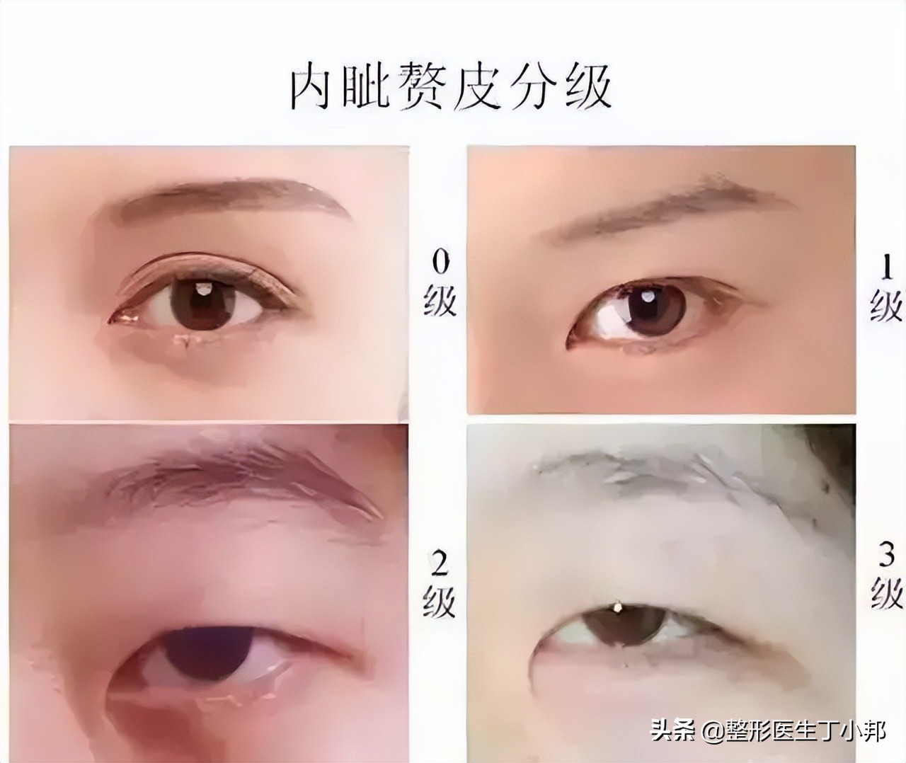 16岁，想做韩式三点双眼皮？需要开眼角吗？整形医生丁小邦解答