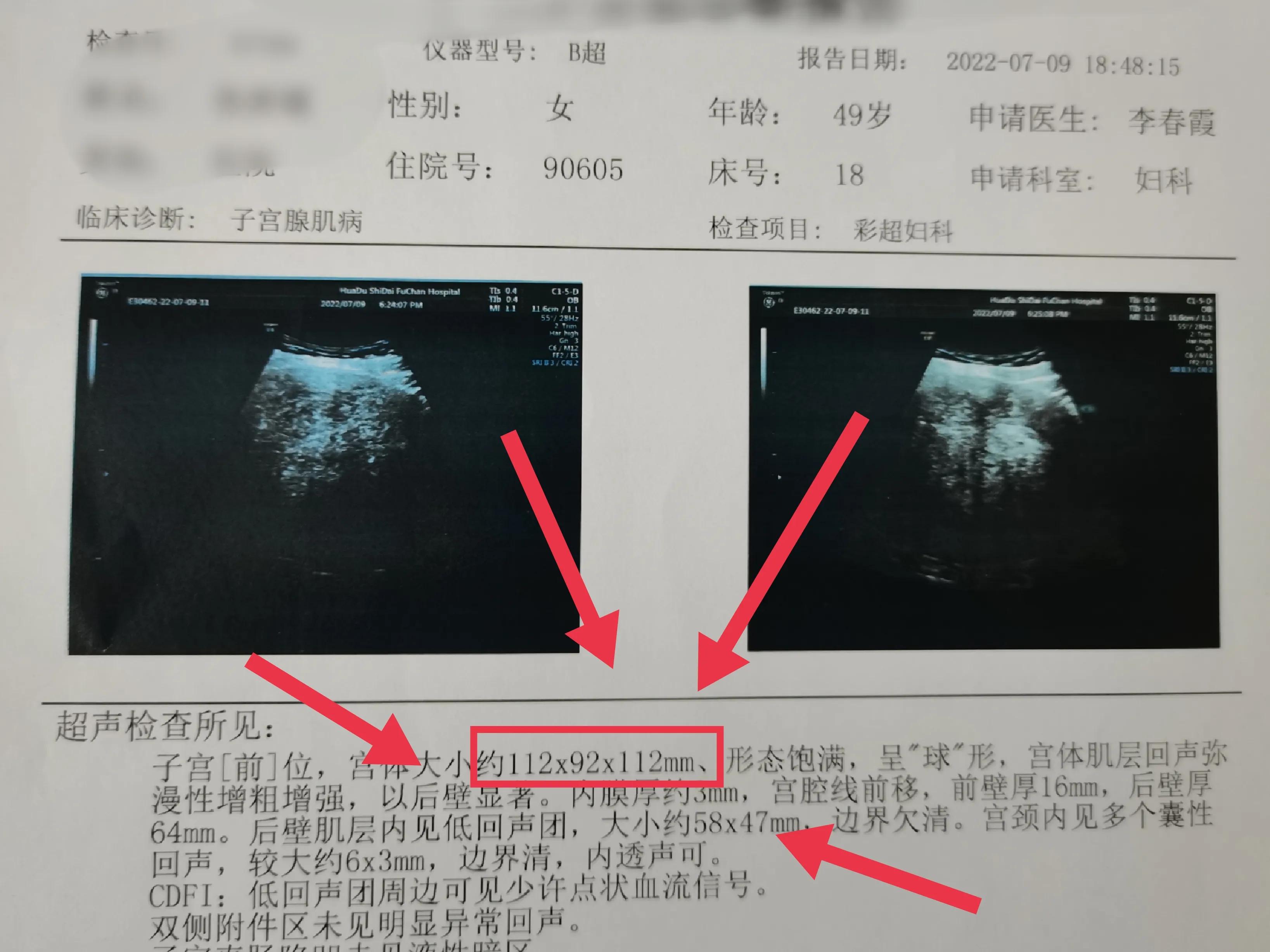 来自浙江的张女士，49岁，深受腺肌症折磨14年