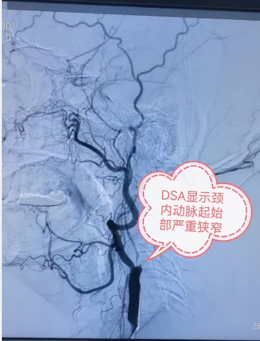 颈动脉剥脱术郑大五附院,中国医大一院颈动脉剥脱术