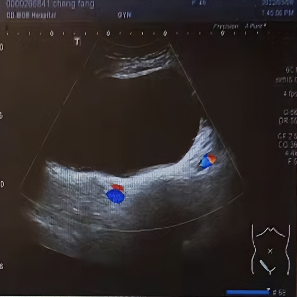 卵巢囊肿微创手术后能清理干净吗,腹腔镜下卵巢囊肿切除术的步骤