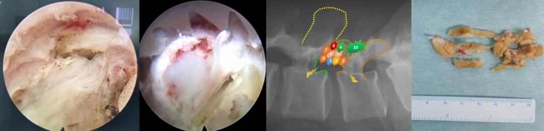 干货|一文掌握Endo-TLIF技术操作要点