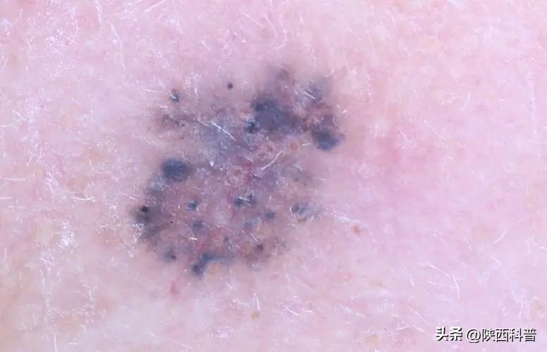 鼻子上的黑头的正确处理方法,鼻子上的黑头大家都是怎么解决的