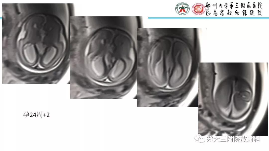 透明隔腔主要是判断什么,透明隔腔宽约10mm什么意思