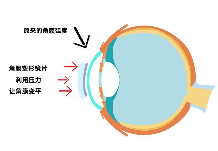 打篮球适合戴ok镜,戴眼镜不能踢足球吗