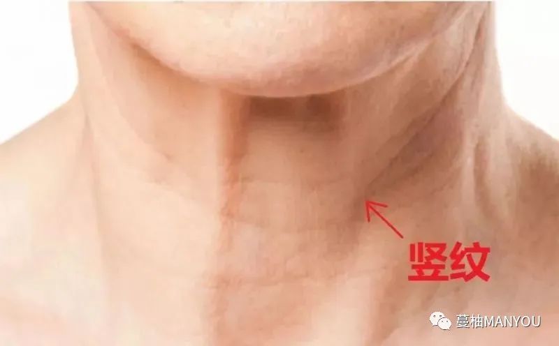 颈纹深怎么快速消除,有什么东西可以帮助淡化脖颈颈纹