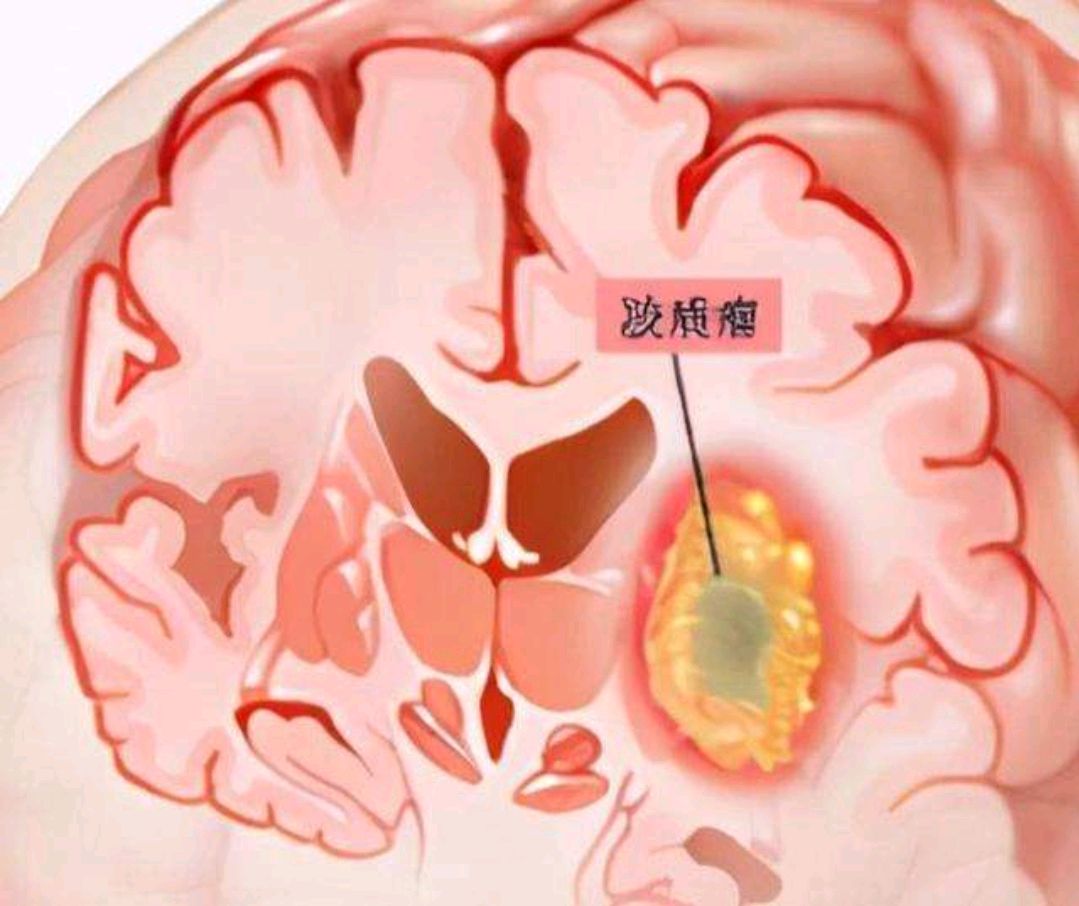 北京胶质瘤名中医李源生,李可老中医治疗脑胶质瘤