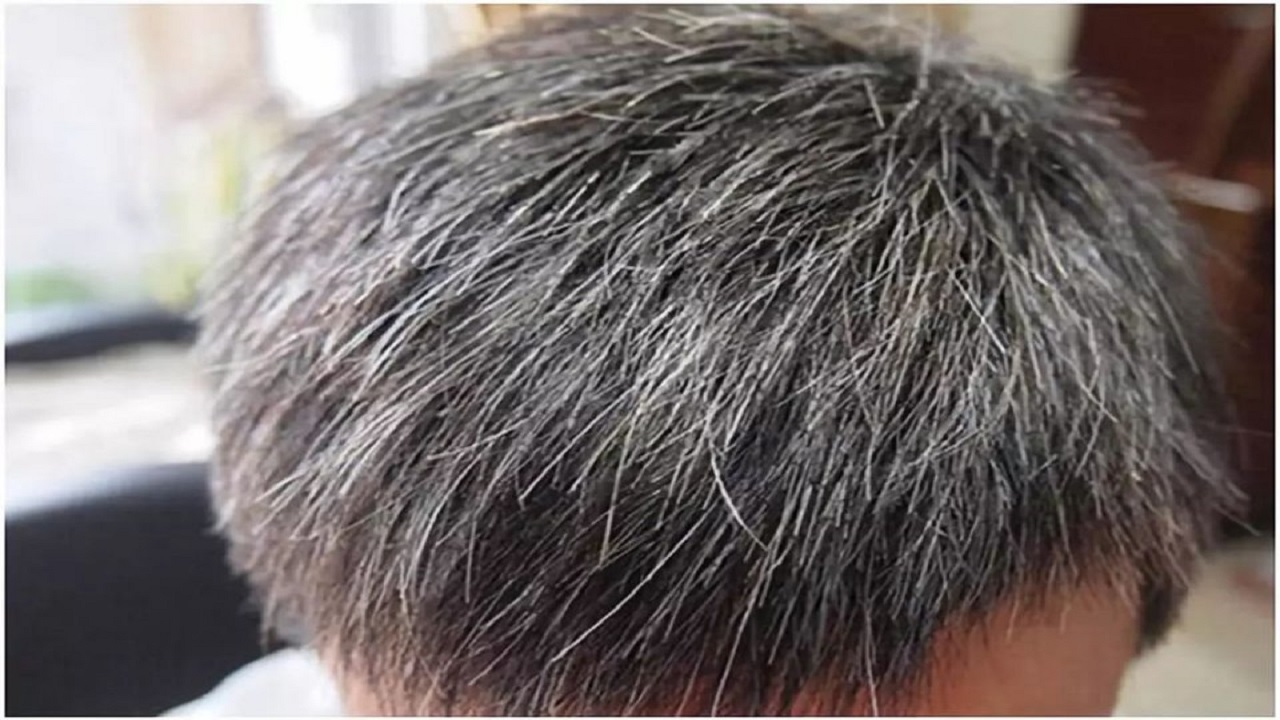 白头发越来越多是缺少什么营养吗,白头发越来越多缺少什么营养吗