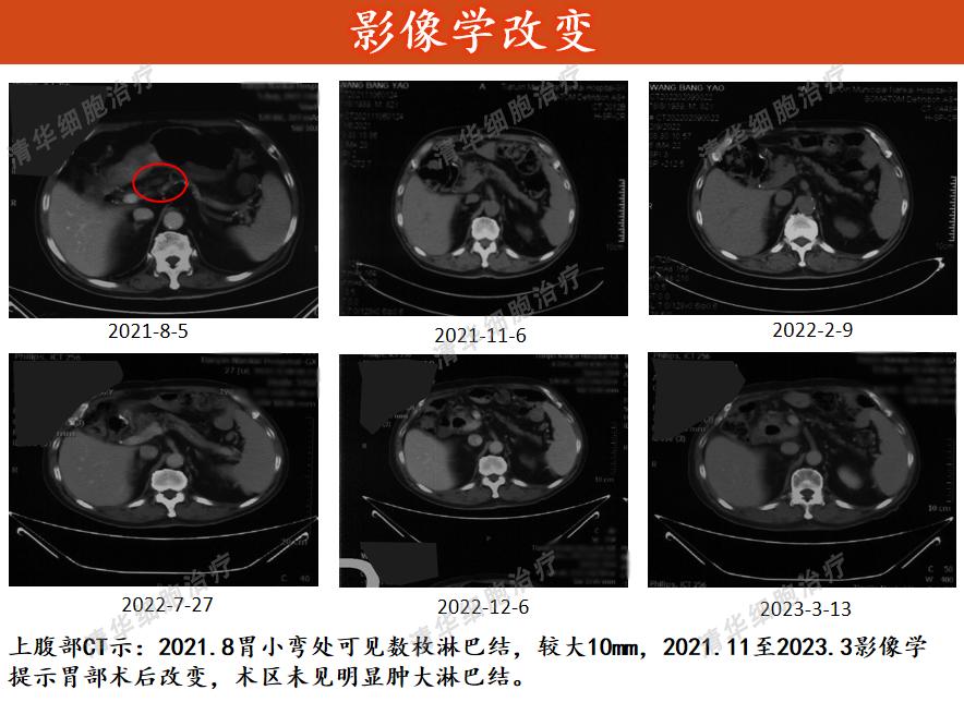 2年前被查出胃印戒细胞癌,现在还好吗?