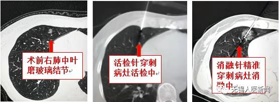 左肺上叶8*5mm磨玻璃结节最坏结果,发现肺磨玻璃小结节怎么办