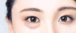 眼袋和卧蚕修复,眼袋大很显老一招眼袋变卧蚕