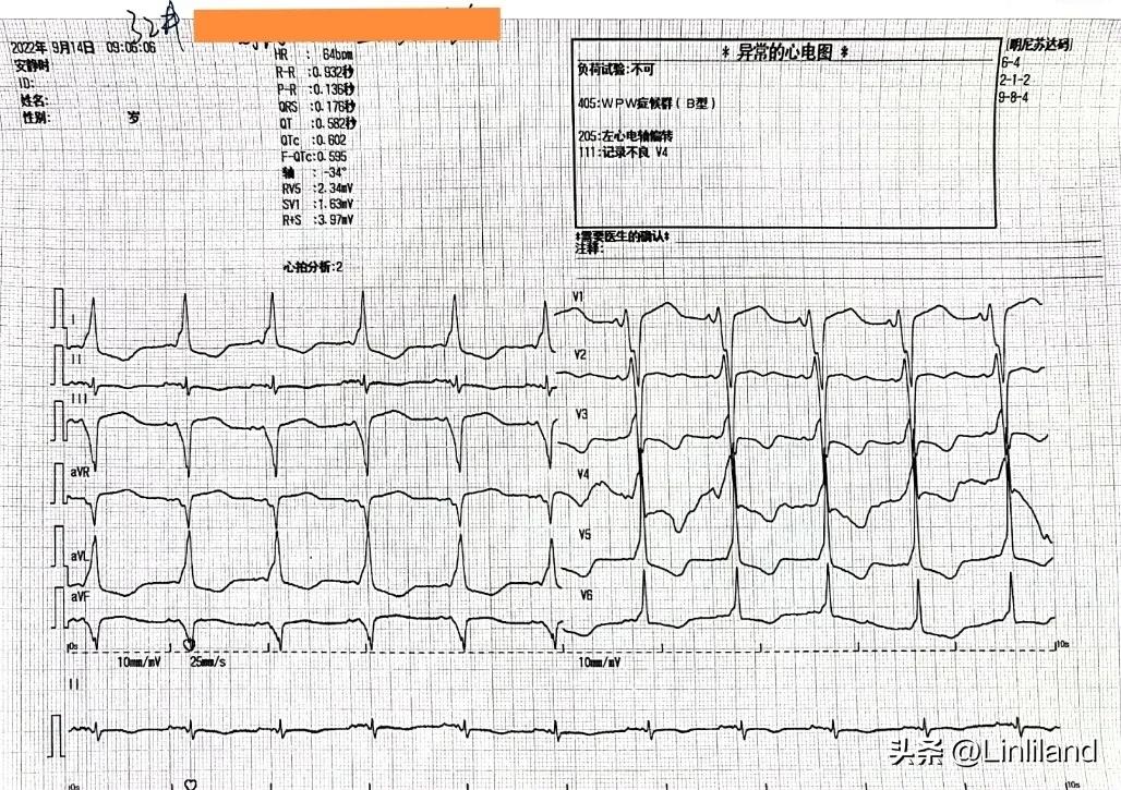 过速性房颤治疗,持续性房颤心动过速