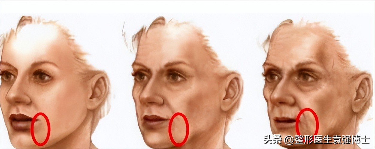 面部皮肤松弛形成口角囊袋,口角囊袋去掉会不会变松弛