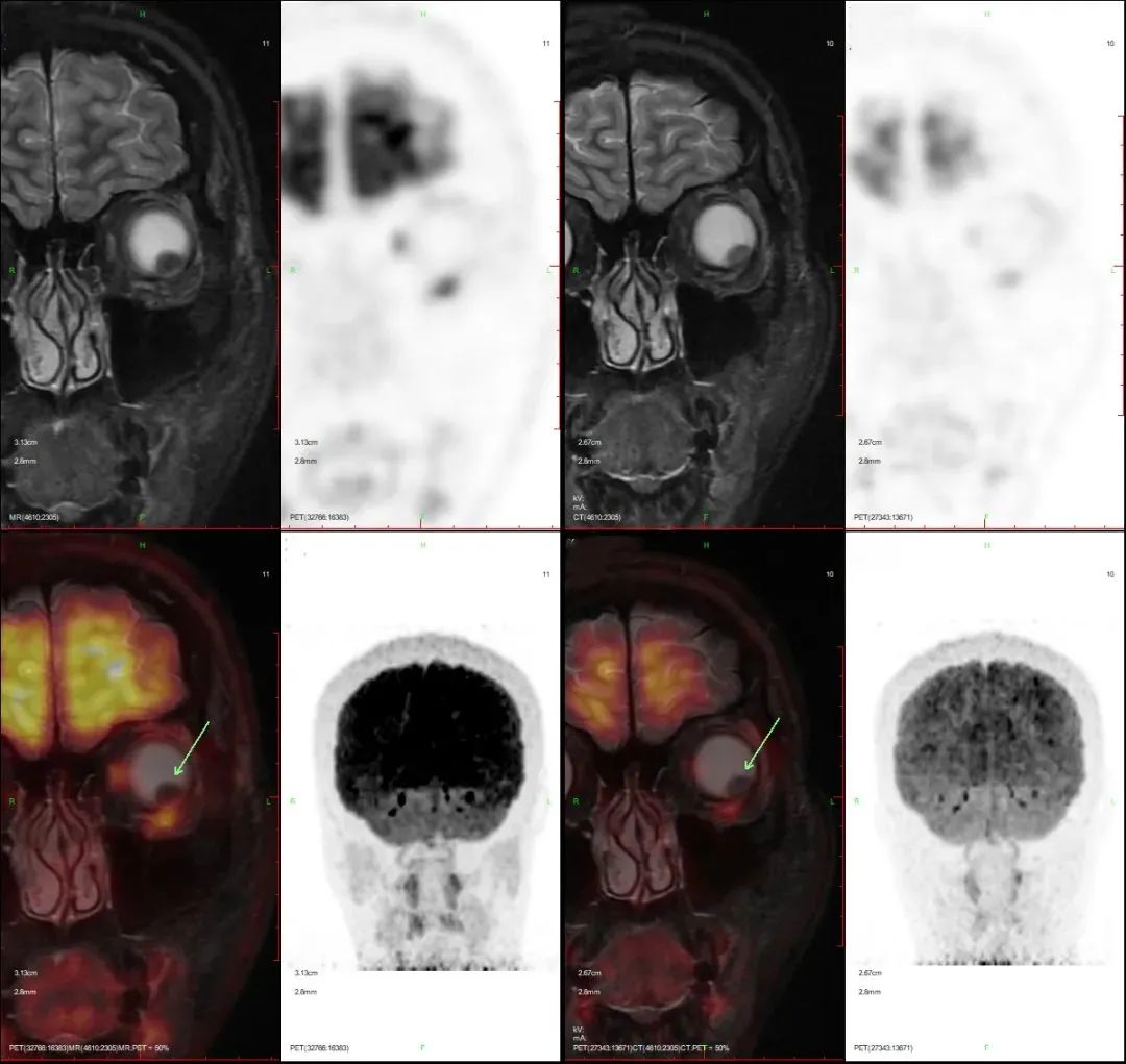濂冲瓙浣撴鏌ュ嚭鑲跨槫,鑺卞灏戝コ纭瘖鐧岀棁鏅氭湡