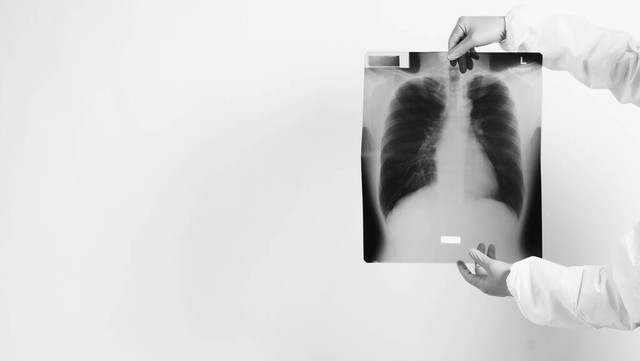 小儿肺部感染引起间质性肺炎原因,肺部感染的正确诊断及编码原则