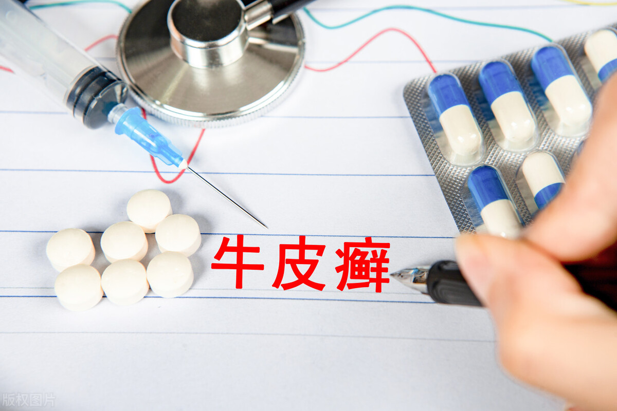 牛皮癣抹激素药裂口咋办,激素药膏对皮肤病有害吗