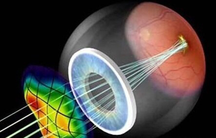 激光近视手术官司,近视眼激光手术算病假吗