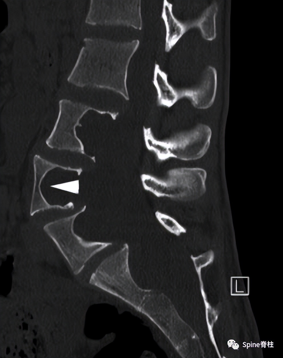 硬膜扩张,duralectasia