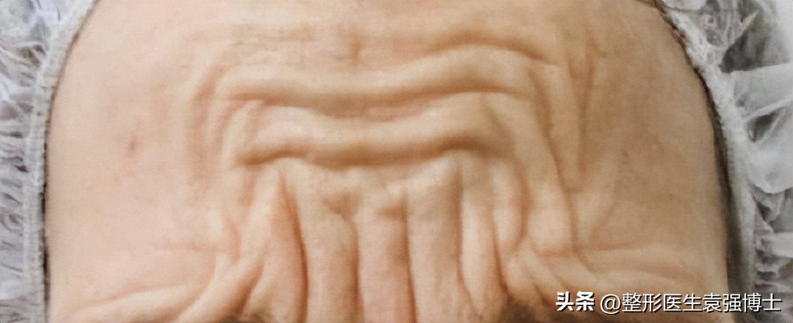 抬头纹影响运势图文,有抬头纹的人运势怎么化解