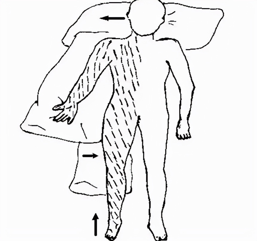 偏瘫早期康复之良肢位摆放,脑梗患者晚上睡觉怎样摆放姿势
