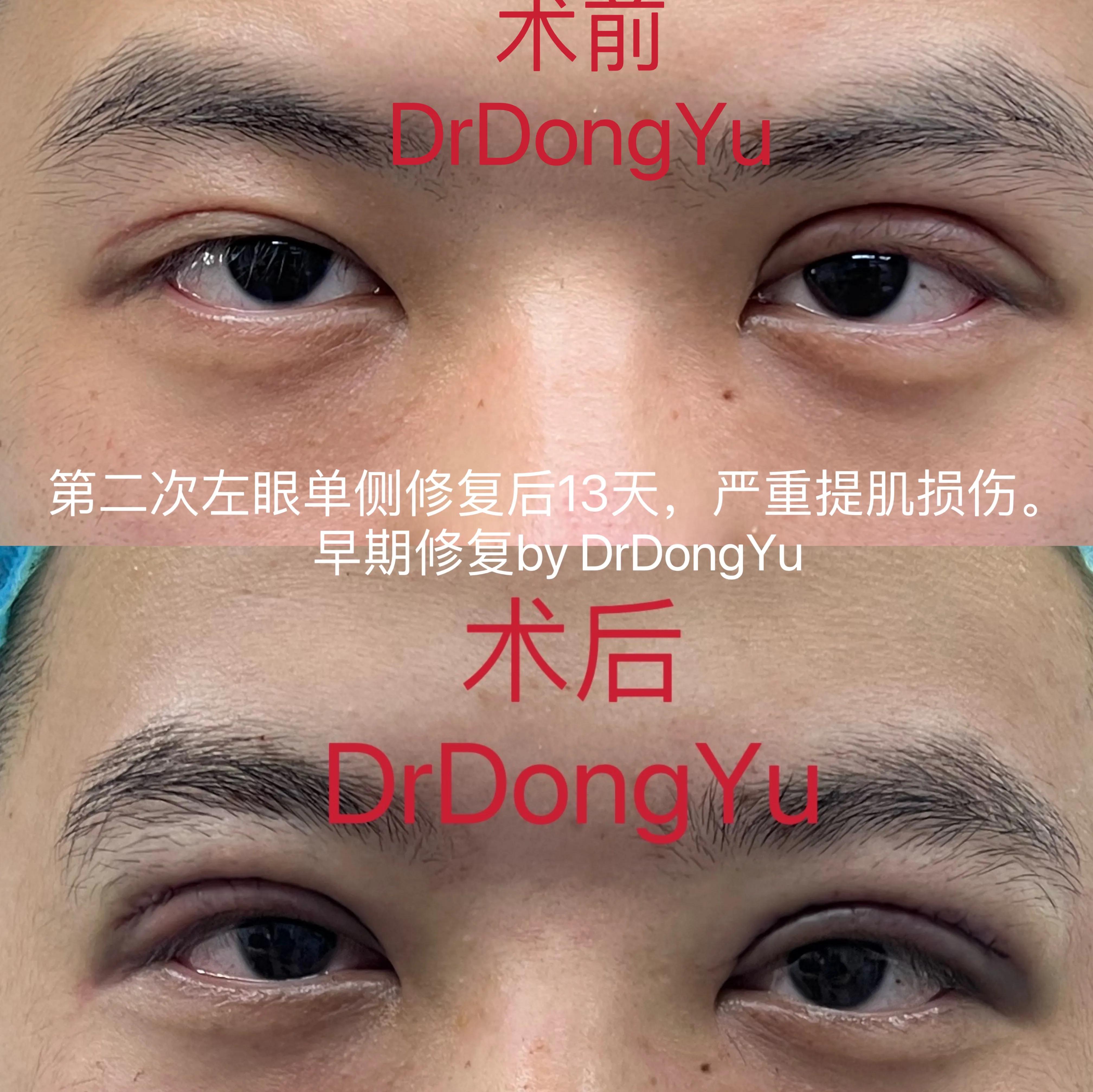 提肌手术多长时间能恢复,严重受损发质修复