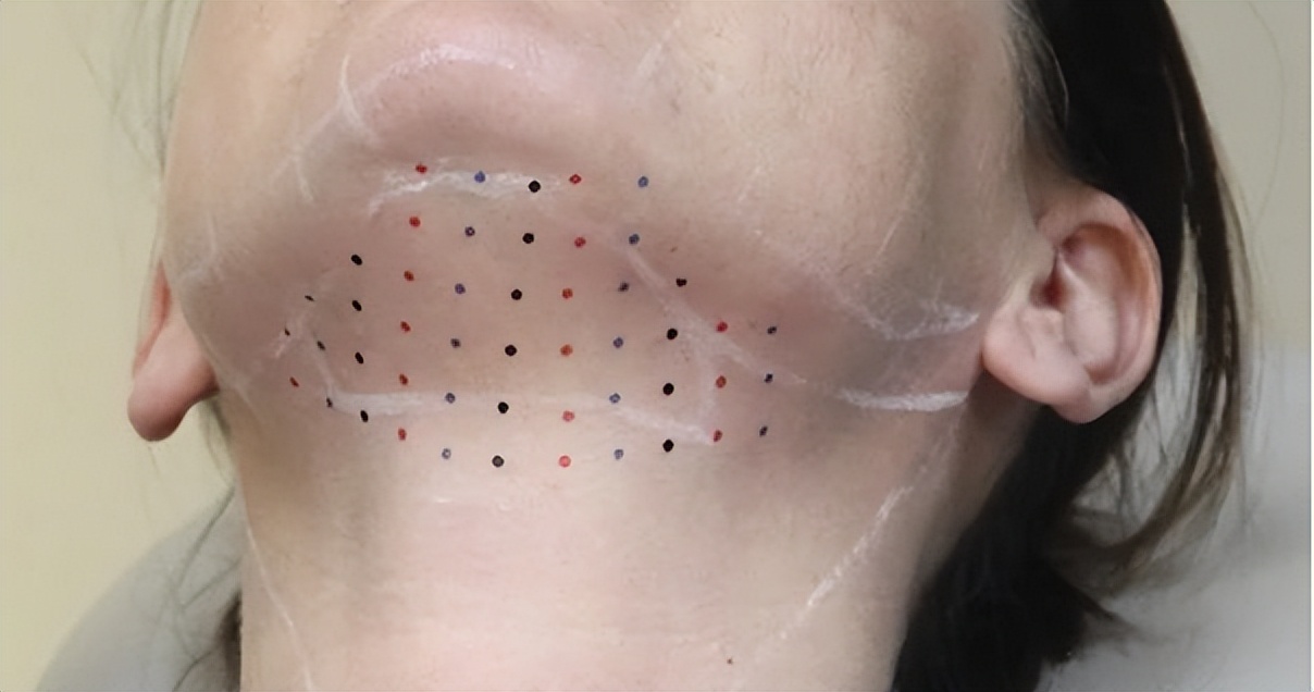 整形医生都不碰的医美项目溶脂针,最强的溶脂针