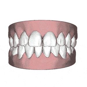 牙齿松动怎么办教你一招恢复,牙齿咬到硬东西松动了怎么办